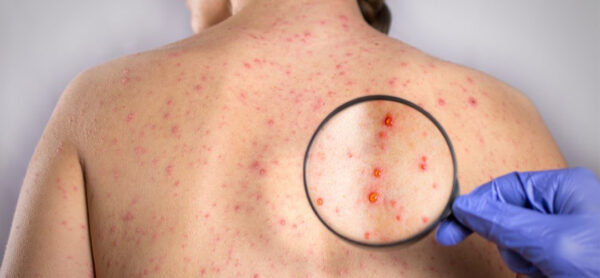 Sífilis requer conscientização